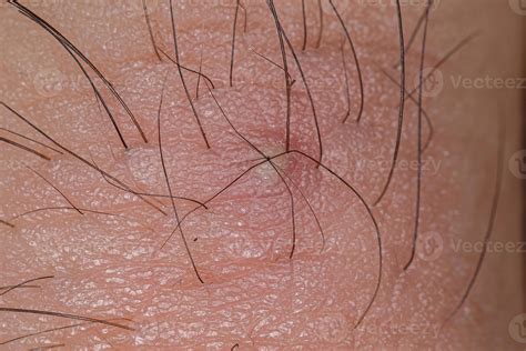 pelos encarnados en la ingle|Pelo encarnado infectado en la ingle: causas, tratamiento y。